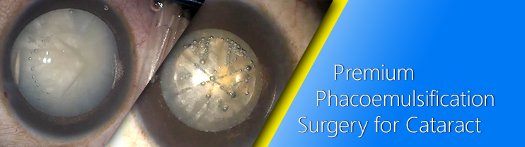Phacoemulsification Surgery at Grewal Eye Institute